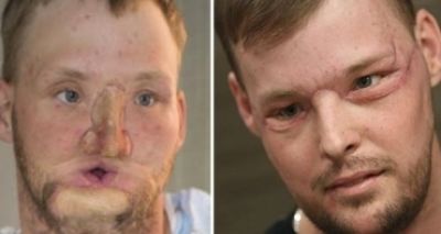 Americano recebe transplante de rosto e volta a usar espelho após 10 anos