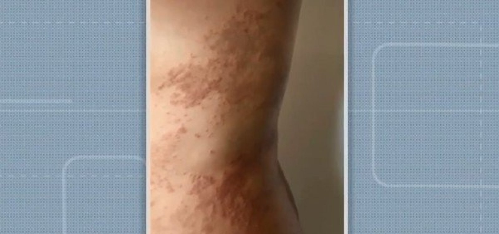 [Mais de 100 pessoas já foram diagnosticadas com doença ‘misteriosa’ no bairro de Patamares, em Salvador]