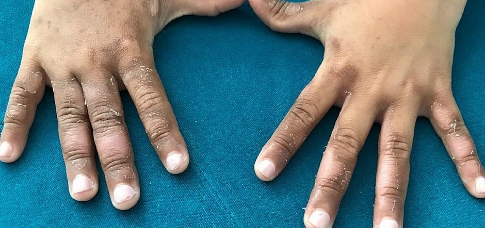 [Menina de 8 anos fica com manchas e bolhas após banho de mar na Ilha de Itaparica]