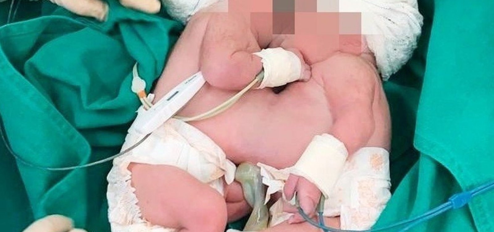 [Morre uma das gêmeas siamesas separadas por cirurgia em hospital de Salvador ]